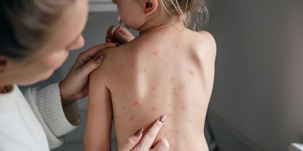 chickenpox vaccine london